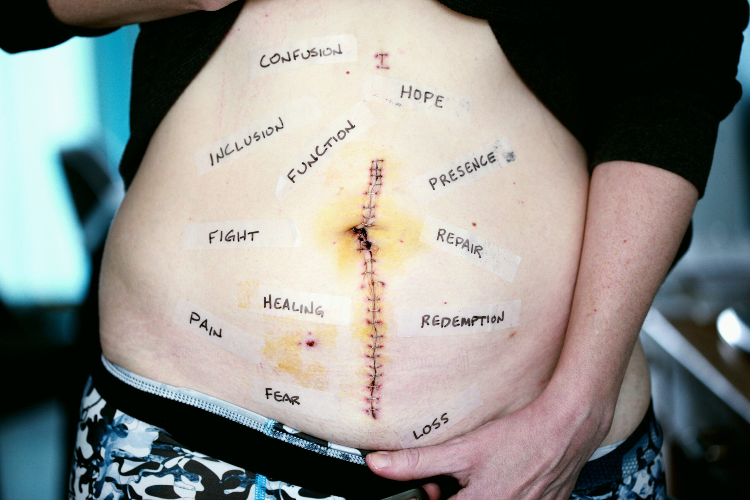 person's tummy with stitches